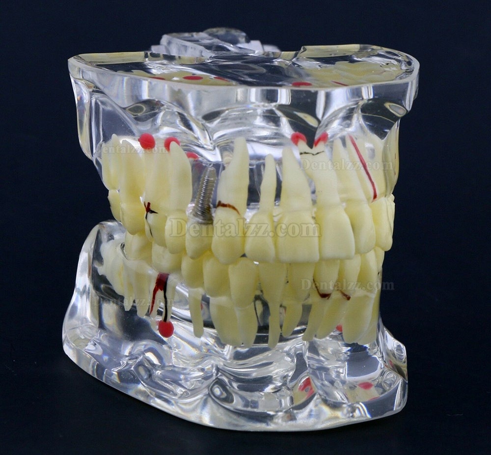 新しい歯科模型 成人病理歯模型 歯列モデル 模型 教学 研究 説明用 #4001